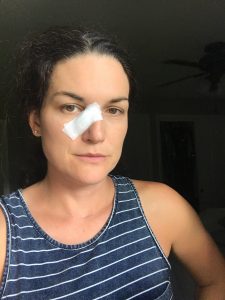 My Experience with the Mohs procedure #skincancer #basilcell #moles